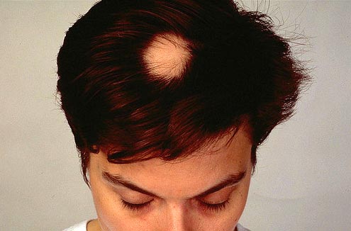 Área calva no topo da cabeça, causada pela alopecia areata