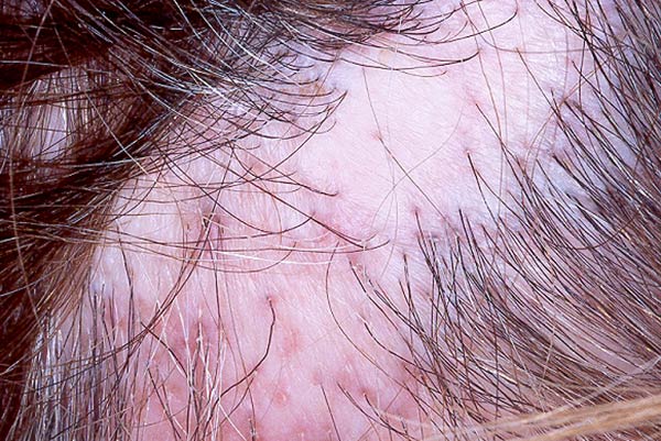 Calvície causada por alopecia cicatricial - liquen plano pilar