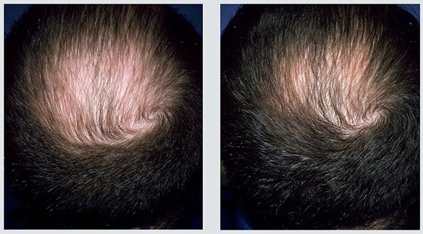 Fotos comparando antes e depois de tratamento de calvície com minoxidil