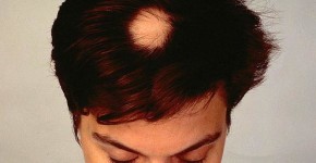 Área calva no topo da cabeça, causada pela alopecia areata