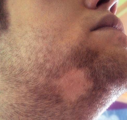 Área calva na barba, causada por alopecia areata