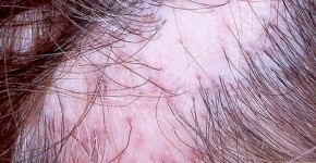 Calvície causada por alopecia cicatricial - liquen plano pilar