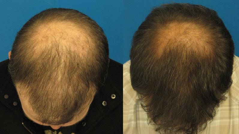 Fotos comparando cabeça antes e depois de tratamento para alopecia androgenética com o remédio Finasterida