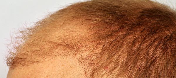 Ilha de cabelo causada por implante capilar realizado em paciente muito jovem