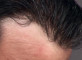 Detalhe frontal de prótese capilar aplicada no couro cabeludo