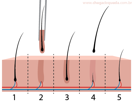 Ilustração mostrando como o cabelo transplantado cai e cresce novamente